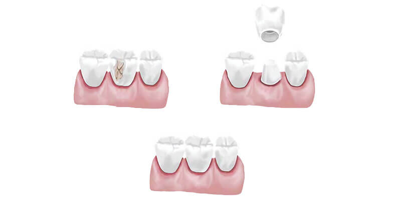 Установка зубных коронок в SDent