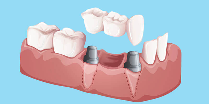 Зубные коронки на импланты в SDent