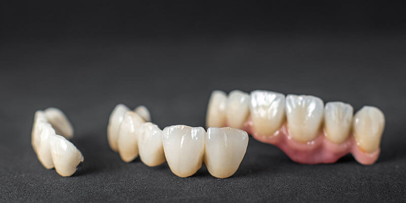 Керамические коронки в стоматологии SDent