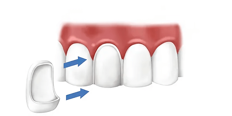 Установка керамических виниров в стоматологии
