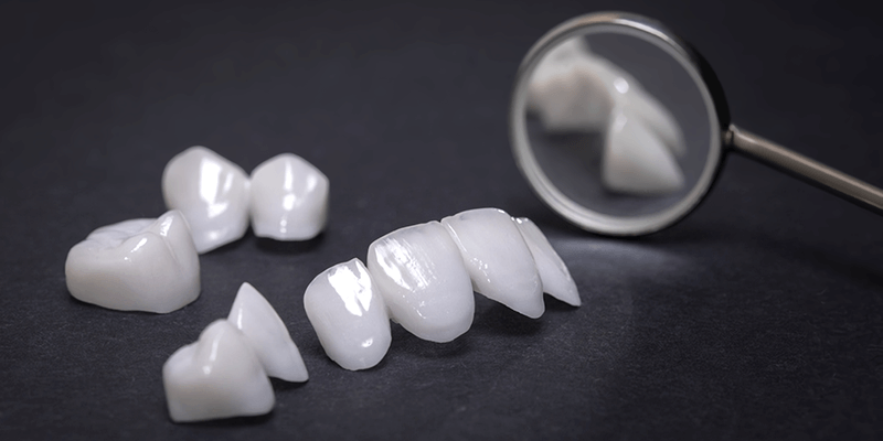 Керамические виниры в стоматологии