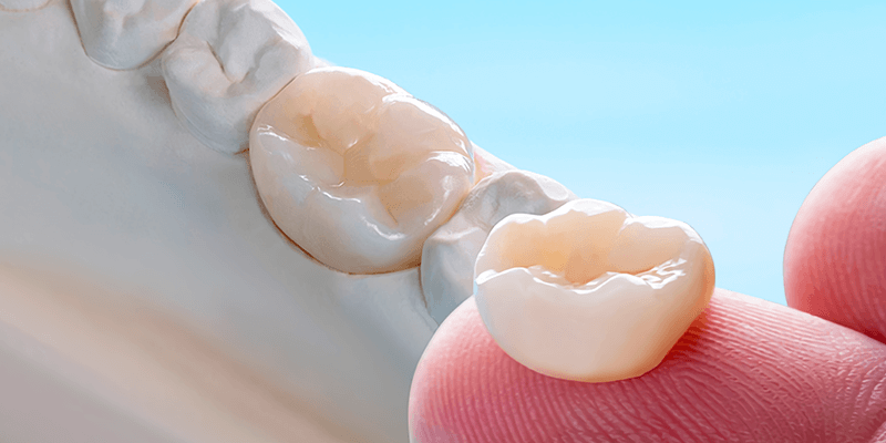 Коронки E-max в стоматологии SDent