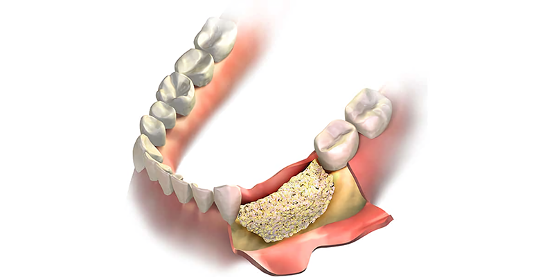 Костная пластика в стоматологии SDent