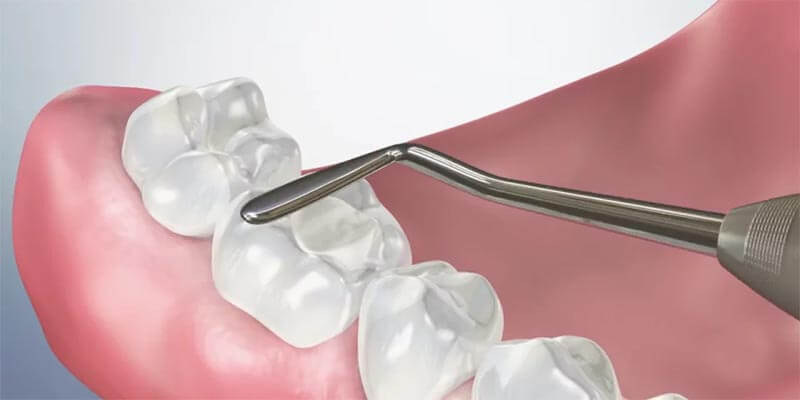 Создание пломбы в стоматологии SDent