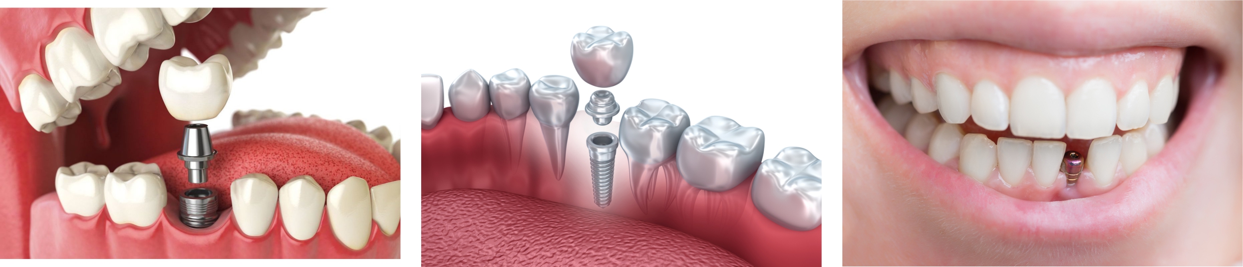 Этапы классической имплантации зубов