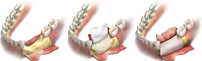 Как проводится костная пластика при имплантации зубов