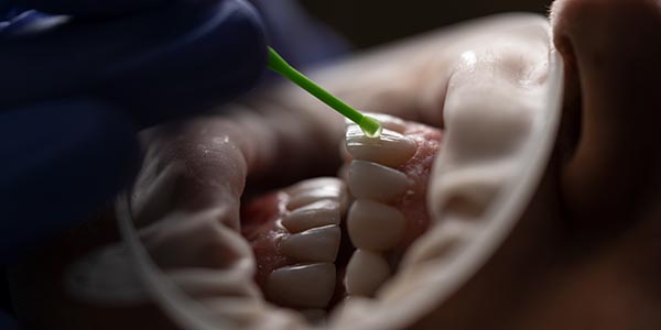 Установка керамических коронок в стоматологии