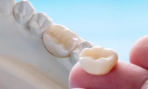 Зубные коронки на импланты в SDent